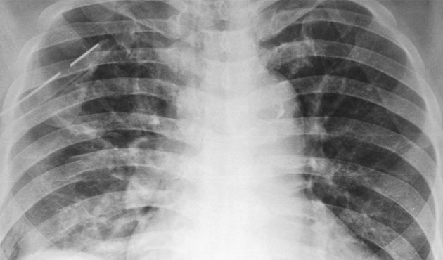Akciğer sönmesi nedir?  Nasıl tedavi edilir?