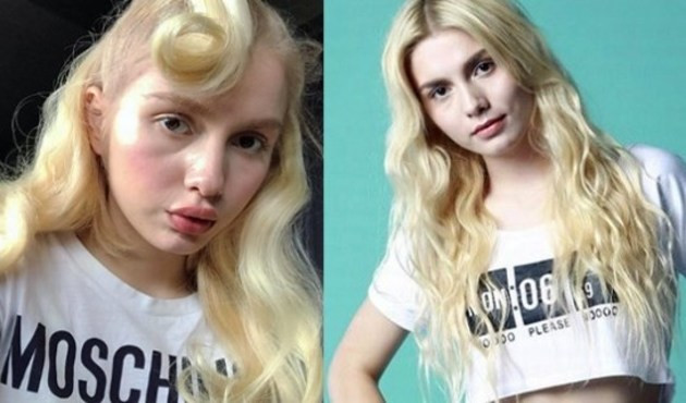 17 yaşındaki şarkıcı Aleyna Tilki'nin 'dolgulu' dudakları olay yarattı!